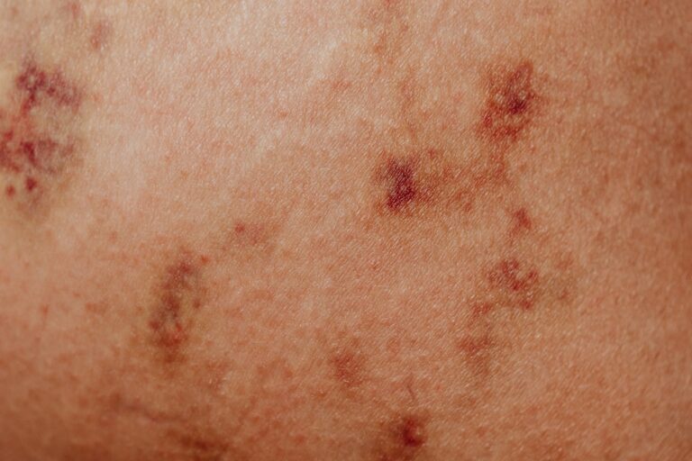 Close up of a Skin with a Disorder